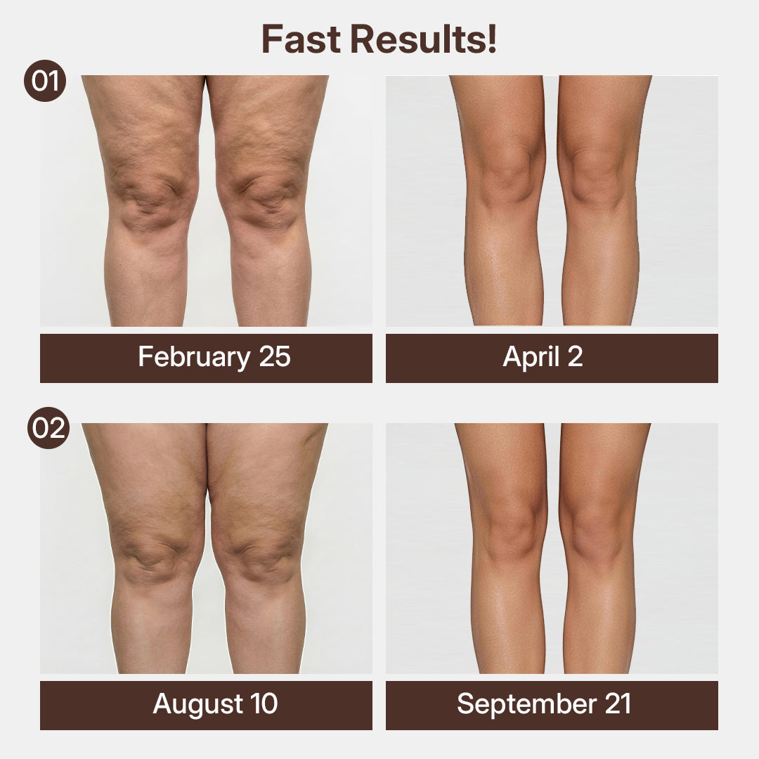 3D Compression Knee Sleeves –Say Goodbye to Saggy, Uneven-Looking Legs