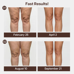 3D Compression Knee Sleeves –Say Goodbye to Saggy, Uneven-Looking Legs